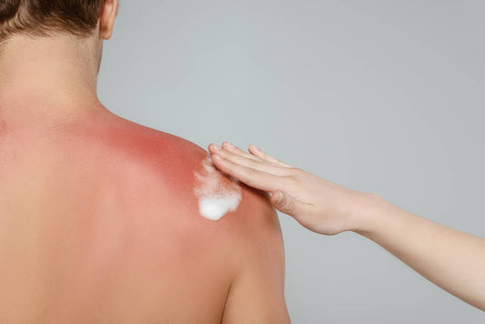 What to Use After Laser Treatments? A Nature-Based Approach to Post-Procedure Skin Relief
