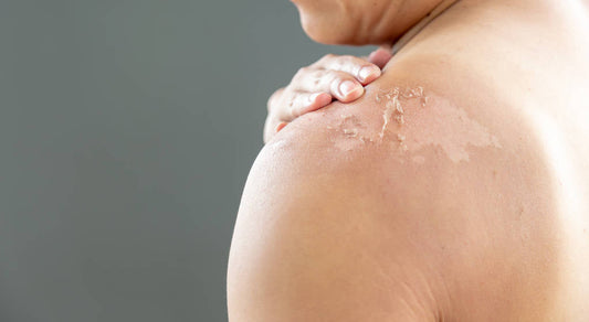 Understanding Your Skin's Recovery Timeline: What Science Tells Us About Post-Radiation Healing